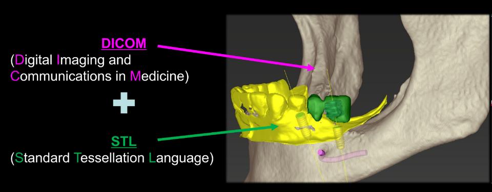 Fig. 1: Superimposed scans from a CT and a digital impression system with virtual implant placement