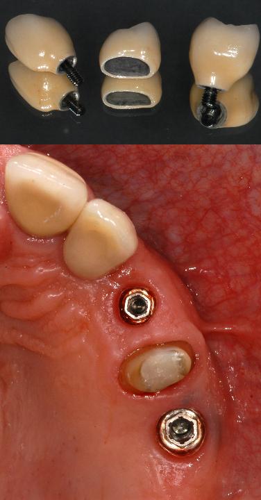 Fig. 9: Externally connected metal abutments and metal-ceramic crowns inserted in region 23, 25 and metal-ceramic crown on tooth 24