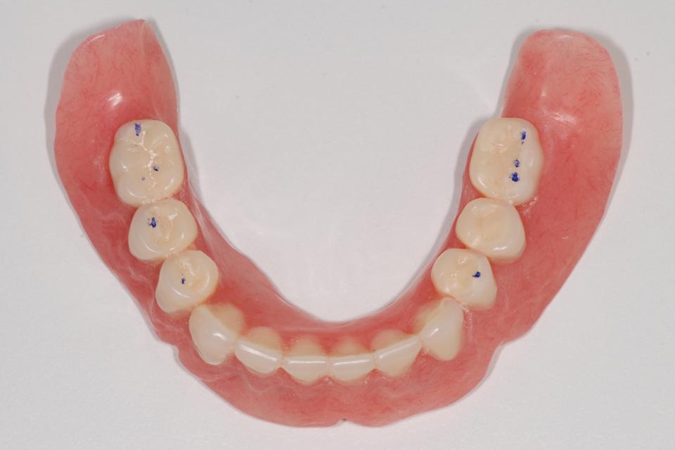 Fig. 16: Mandibular denture with marked centric occlusion contacts at the moment of the incorporation