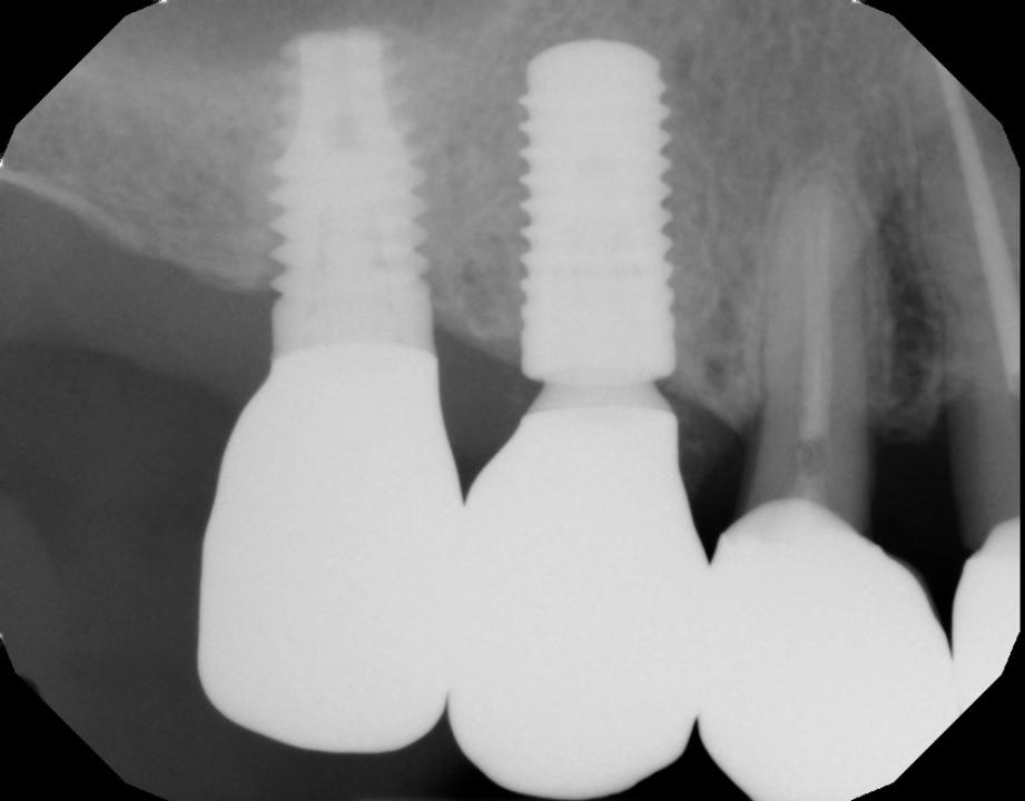 Fig. 12: 8-year-old implant with matching diameter implant and abutment shows 1-2-mm bone loss while adjacent 4-year-old platform-switched implant shows no bone loss