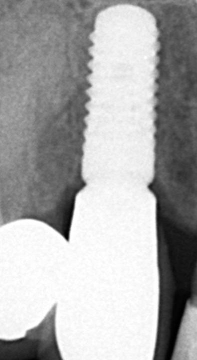 Fig. 26: The corresponding periapical radiograph (left) confirms the stability of the crestal bone, while the oro-facial CBCT cut shows a fully intact facial bone wall with the peak coronally located to the implant shoulder