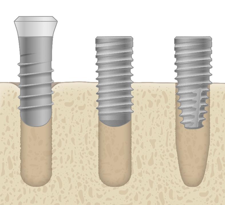 Fig. 6a: Diagrammatic representation of the implant macro-designs assessed. a) TL, BL and BLT implants entering the osteotomy. Note the BLT implant is guided by the osteotomy walls only after the apical 5 mm has entered the osteotomy; b) TL, BL and BLT implants within the osteotomy