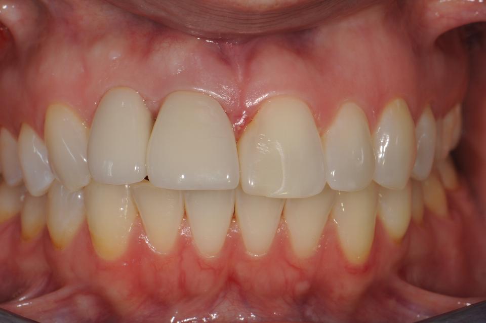 Fig. 18a: Facial view showing discoloration and graying of the labial gingiva near the margin