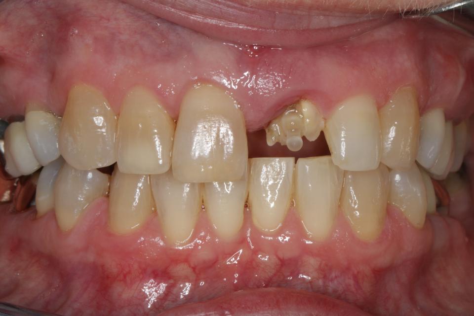 Fig. 10: Male patient with hopeless central incisor