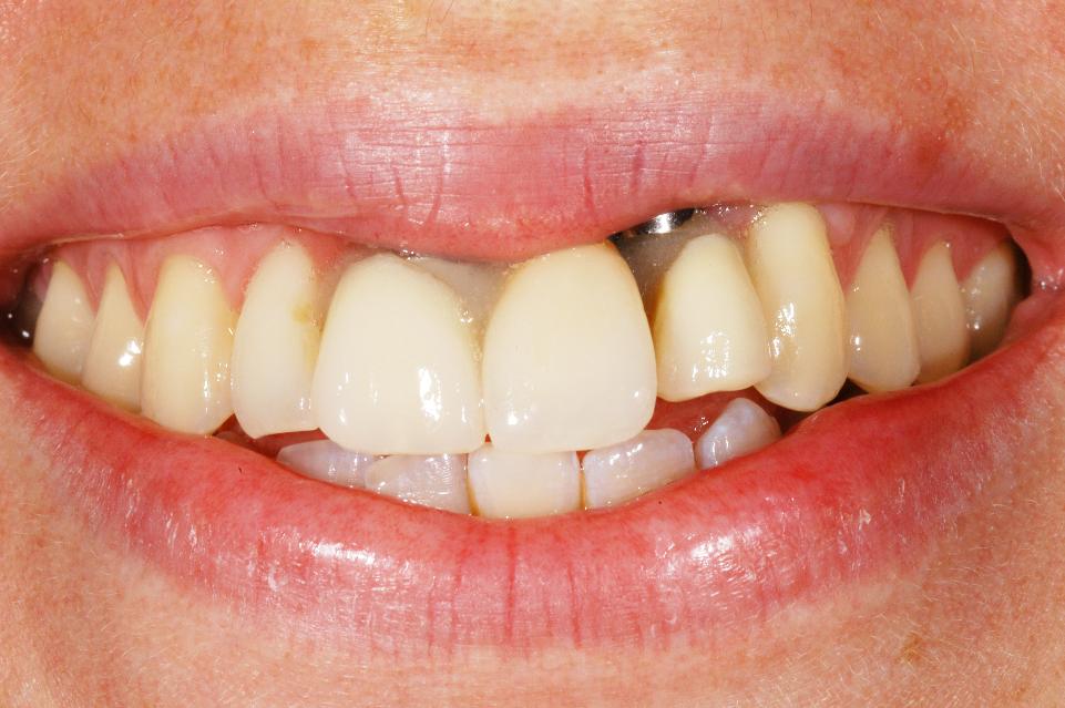 Fig. 8b: The patient’s non-forced smile with the provisional removable partial denture in place visualizes the significant negative impact of the malpositioned implants on esthetic appearance