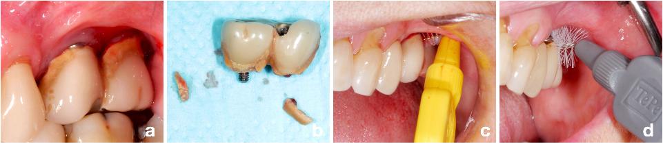 图7: 图5中的患者，提示我们在任何治疗前都需要进行口腔卫生指导(a - c)，手术治疗后也需要进行相应的适当的口腔卫生维护措施，即，术后需要一个更大的牙间隙刷(d)