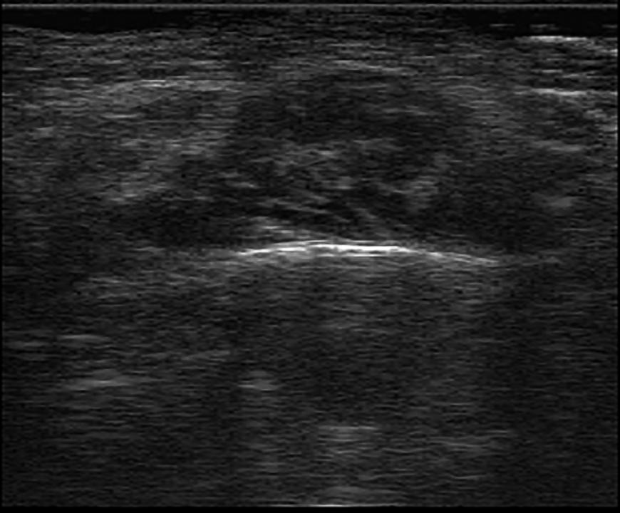 Fig. 4: Grosor del músculo masetero medido en un corte ultrasonográfico