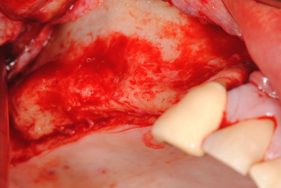 Fig. 4: Mucoperiostal flap to expose the recipient site