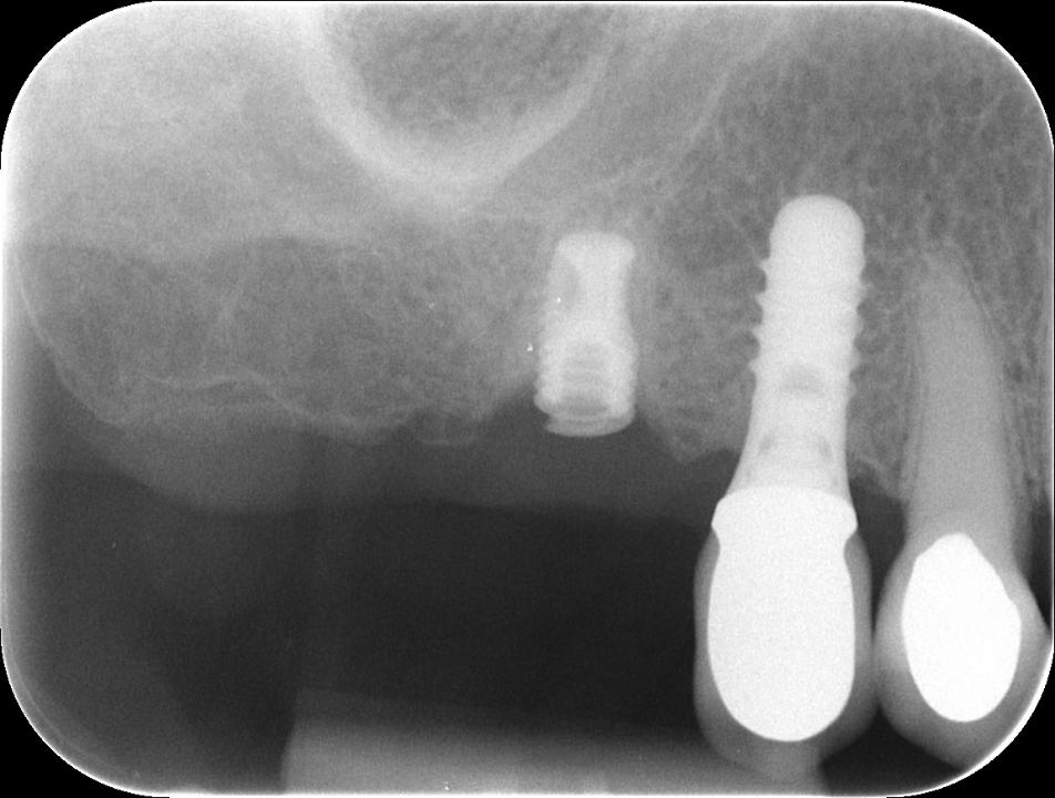 図１b: 25年後の16番（右上第一大臼歯）のブラキシズムによるインプラント破折（75歳男性、下顎固定式インプラント修復） [Source: N. U. Zitzmann]。埋入から25年後のX線画像。インプラントの破折