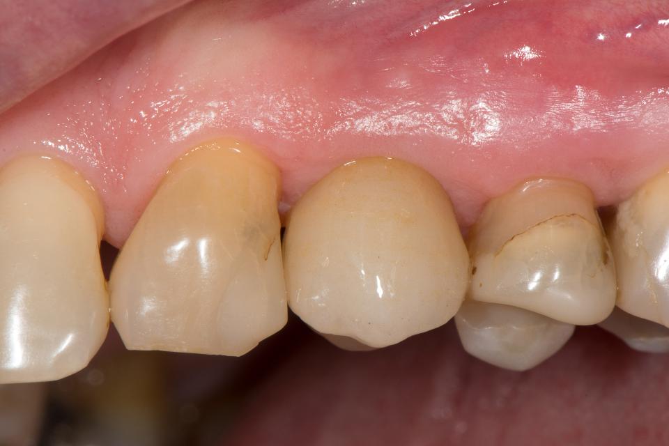 Fig. 4f: Follow-up 5 years after implant placement, exhibiting healthy peri-implant tissue condition (Photo credit: Stefan Roehling)