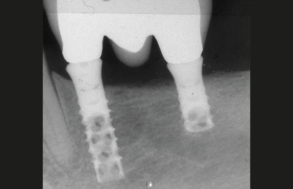 Fig. 6: The first 6-mm short implant placed in the Department