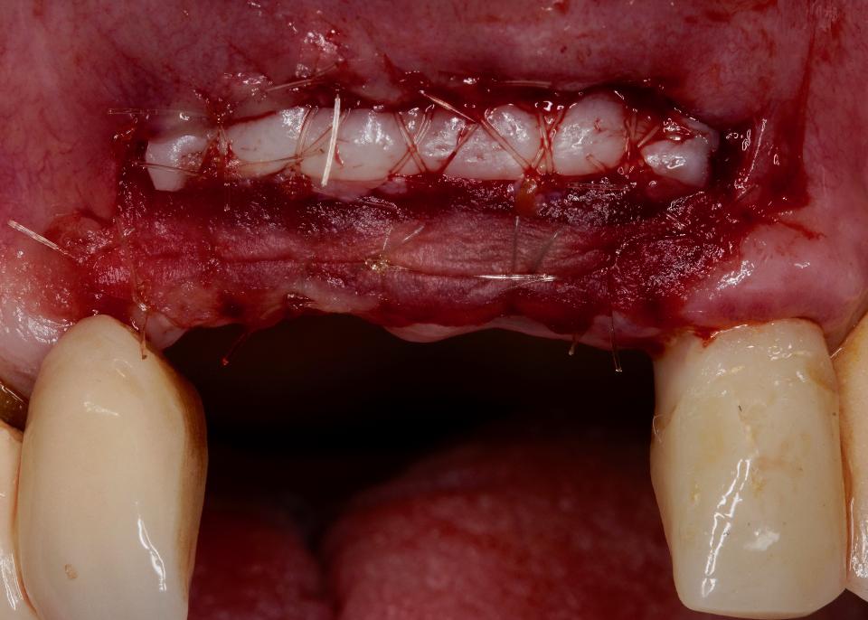 図12: 角化粘膜の幅を広げるために、遊離歯肉移植片を根尖側移動弁の歯冠側に固定した。手術部位の両縁に角化粘膜があると、同じ組織の移行が予想される。異種由来の軟組織代替材料をこれらの辺縁の間に固定し、再生を助けた