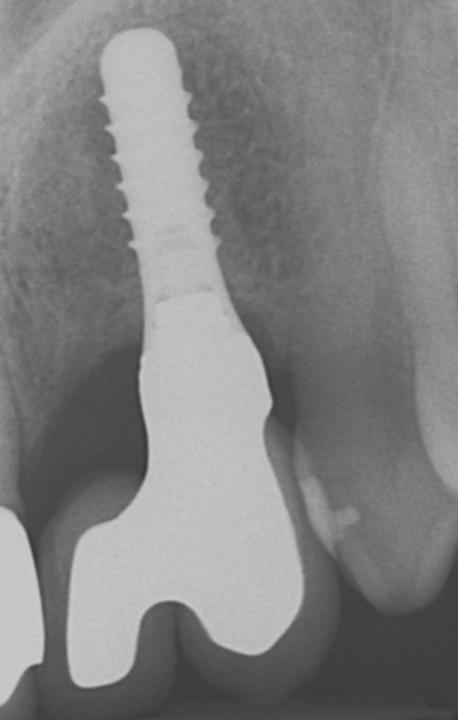 Fig. 4e: The corresponding post-operative peri-apical radiograph documents favorable bony conditions associated with the solid screw-type soft tissue level implant. Note also the adequate dimensions of the underlying metal framework, particularly in the connecting area, to provide optimal mechanical resistance