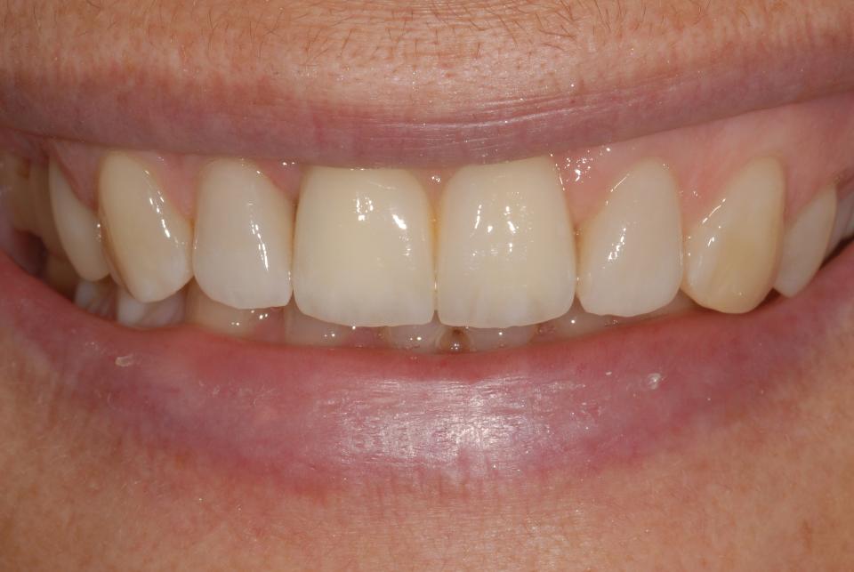 Fig. 5h: The direct comparison before (5g) and after (5h) completion of the combined adhesive and implant-based therapy documents a distinct enhancement of a previously quite compromised situation. It must be said that the patient had an ideal smile line position for this kind of restorative design, allowing optimal benefit from the addition of pink ceramics. This in turn allowed the elimination of the black triangle, as well as the re-establishment of balanced relative-tooth dimensions