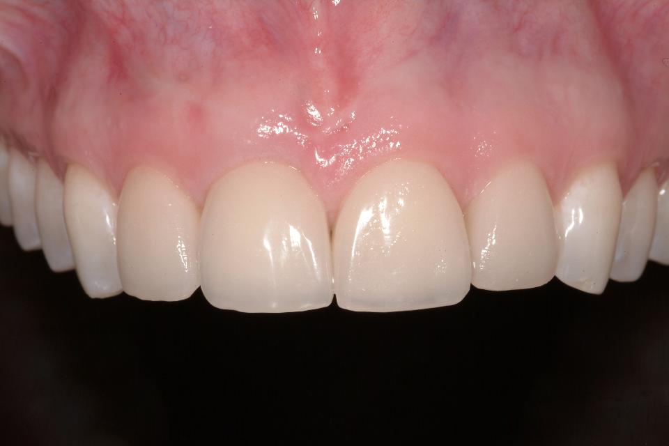 Fig. 19a: Facial view showing maintenance of labial contour and interdental papillas without gingival color change