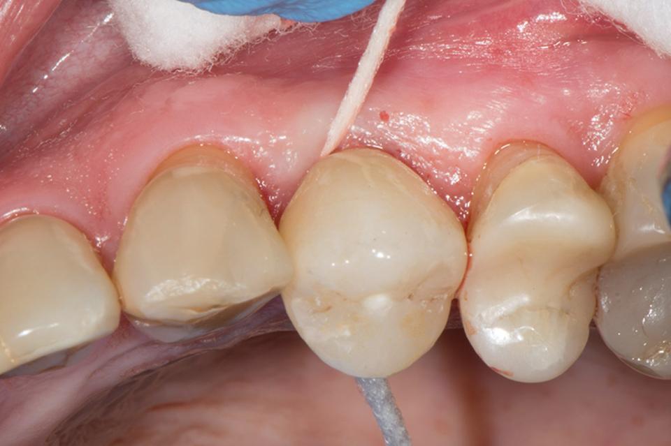 Fig. 4d: Clinical situation at cementation of definitive monolithic zirconia crown 4 months after implant placement. In the restorative phase, a defined cementation protocol was required: cement draining hole and application of superfloss to remove excess cement (Photo credit: Stefan Roehling)
