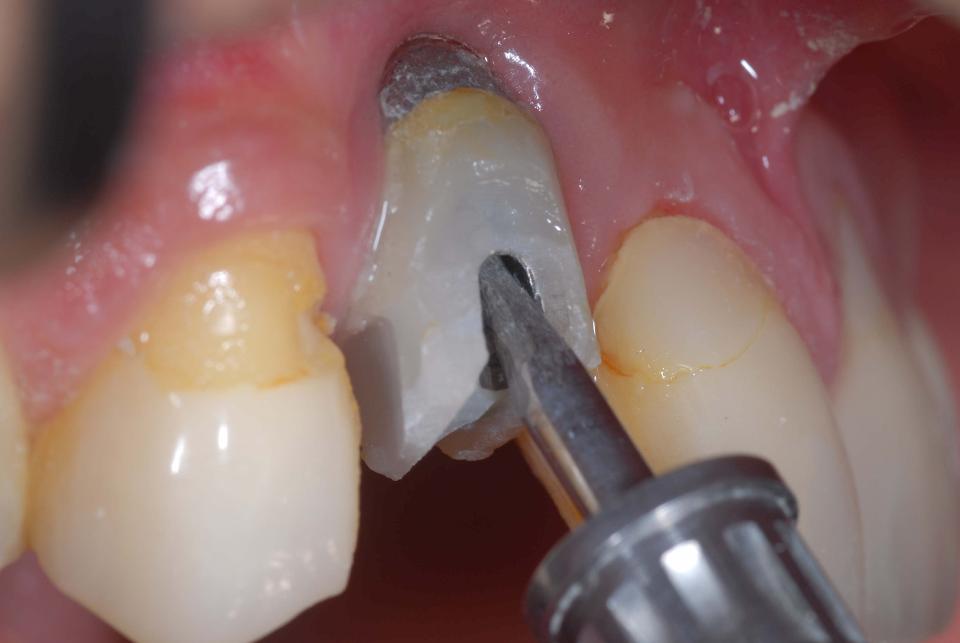 Fig. 5b: After implant crown removal, an extreme labial implant axis becomes apparent