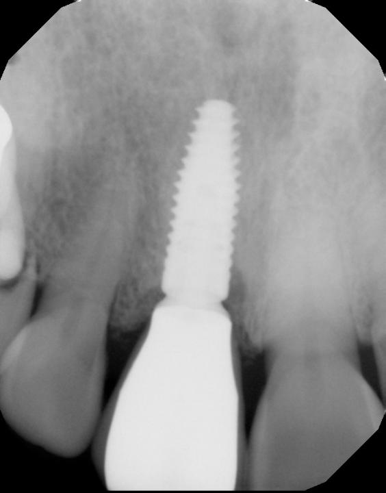 Fig. 17b: Radiograph showing excellent crestal bone maintenance