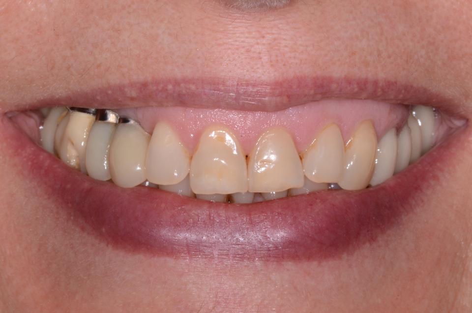 Fig. 11a: A sixty-year old female patient’s non-forced smile visualizes the significant negative impact on esthetic appearance, namely the exposure of metal, created by several malpositioned implants in the right maxilla