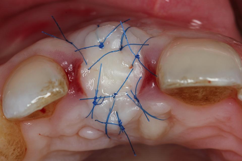 Fig. 27: Clinical situation following soft tissue grafting with a free gingival autograft