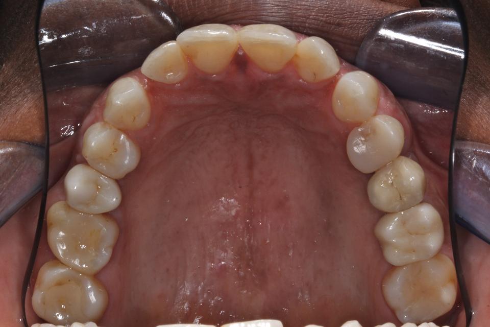 Fig. 7b: Prosthetic restoration with monolithic full-zirconia crowns