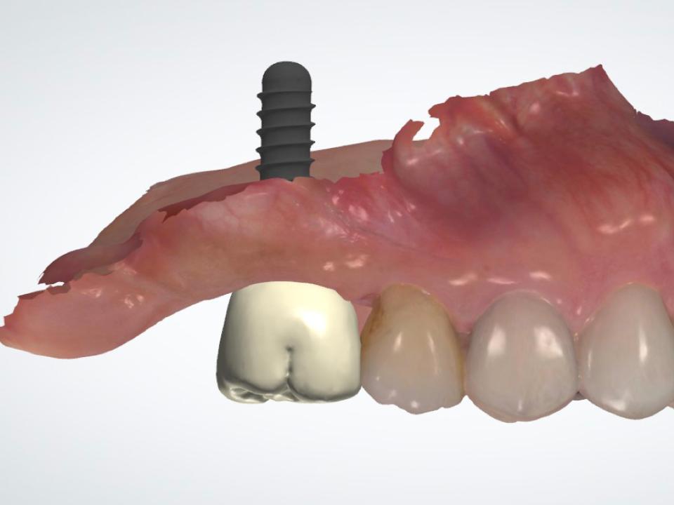 Fig. 1d: Diseño asistido por ordenador (CAD) para corona atornillada implantosoportada