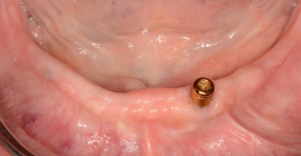 Fig. 32: Severe atrophy after implant loss 43