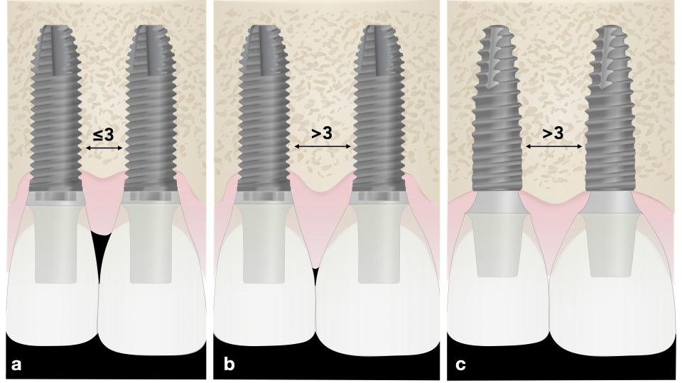 Fig. 14: Adjacent implants in the esthetic zone. a: External hexagon implant connections with platform matching abutments and an inter-implant distance ≤ 3 mm. The saucerization processes were combined, resulting in loss of bone height, and inter-implant papilla, and formation of a black triangle. b: The same implant connection and abutments, but respecting a minimum distance wider than 3 mm, observe the saucerization processes around both implants, separated by a bone crest. c: Conical connections implants with platform-switching abutments, resulting in a minimum bone loss, and presence of inter-implant papilla