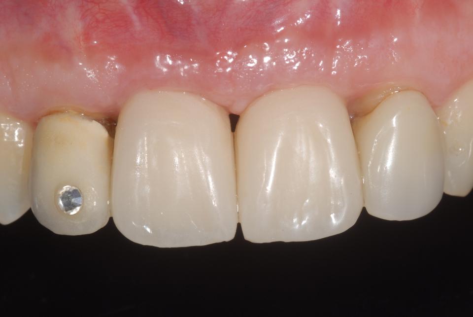 Fig. 6h: After four weeks the provisional implant restorations favorably contributed to peri-implant soft tissue conditioning and tissue maturation. The level achieved of the peri-implant mucosa on the one hand and the gingiva at the adjacent crowned teeth on the other indicates that the final implant crowns will fulfill standard esthetic expectations and that new crowns on teeth 12 and 22 are indicated to assure an acceptable overall integration