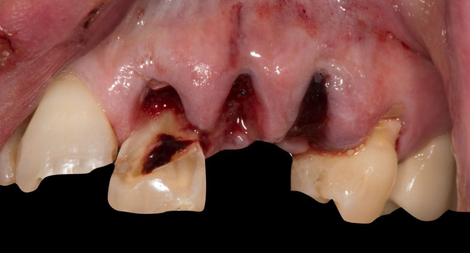 Fig. 5a: Clinical case 2: 1-piece zirconia implant-supported single crown and 3-unit implant fixed dental prosthesis. Patient injured front teeth by trauma and wanted a metal-free treatment option (Photo credit: Stefan Roehling)