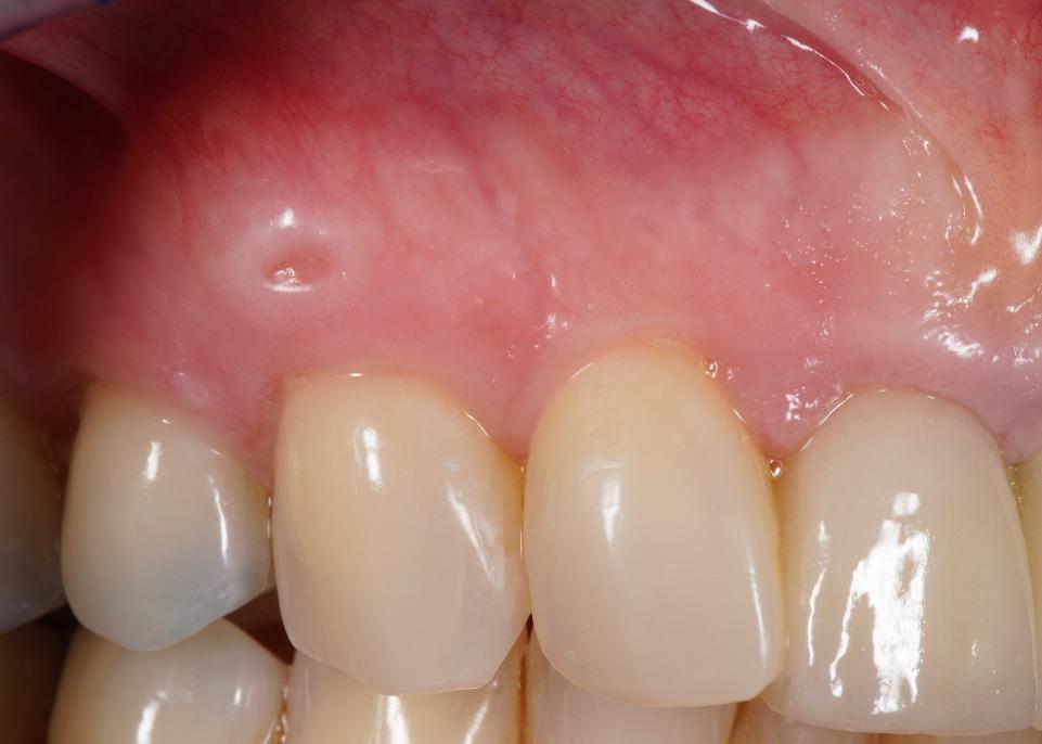 图10: 使用取自腭侧的去上皮游离龈移植物覆盖牙龈退缩的尖牙。随着时间推移，软组织体积增加，超过了原有的移植物体积。此外，临床检查时发现下层上皮透过表面黏膜穿孔