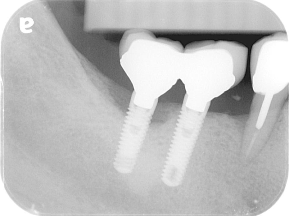 Fig. 5b: Imagem radiográfica da Fig. 5A mostrando que a descimentação das coroas esplinatadas está associada à perda óssea peri-implantar do implante distal