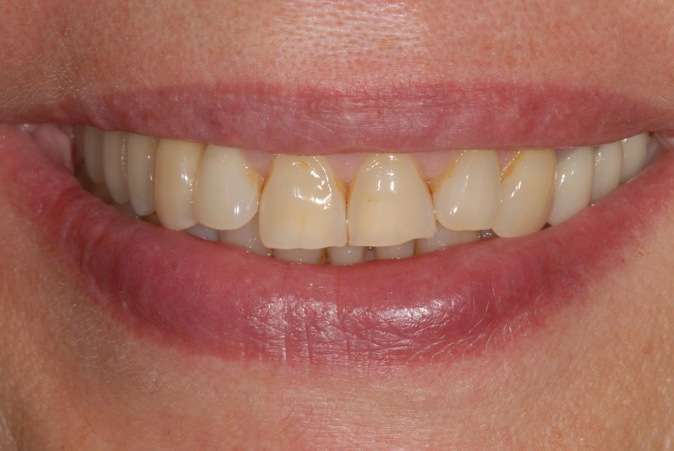 Fig, 11o: The patient’s non-forced smile at the end of treatment