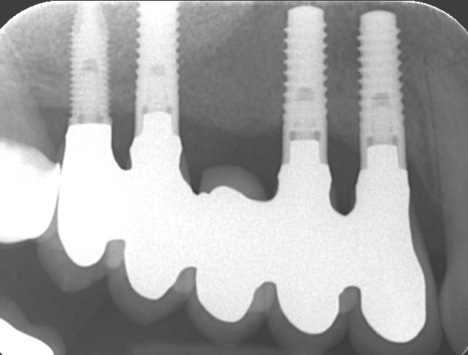 Fig. 11n: The x-ray of the final implant supported FDP confirms stable peri-implant bony conditions and adequate marginal fidelity of the suprastructure