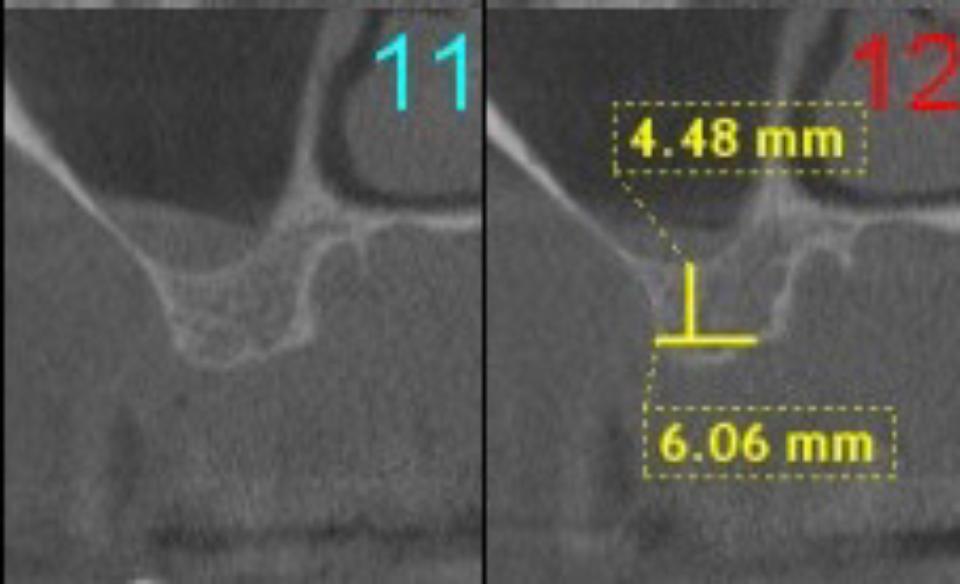 Fig 1a: Pre-op CBCT showing insufficient vertical bone dimension to place an implant