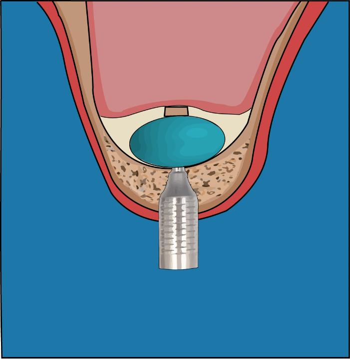 Fig. 9: Schematic diagram of MSFE via minimally invasive antral membrane balloon elevation. The inflated sinus elevation balloon gently elevates the sinus membrane at the osteotomy site