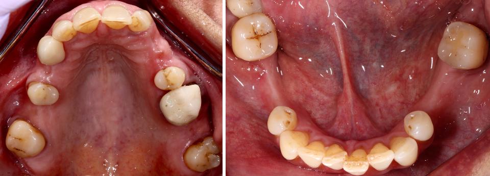图6: 下颌和上颌存在部分牙缺失。缺牙处可见牙槽嵴萎缩。这一常见的观察结果是De Souza等人(2023)在系统综述中所提出问题的基础：在部分或完全牙缺失患者中，与传统修复治疗或不治疗相比，种植修复体是否能够保存口面部组织(包括骨体积)?