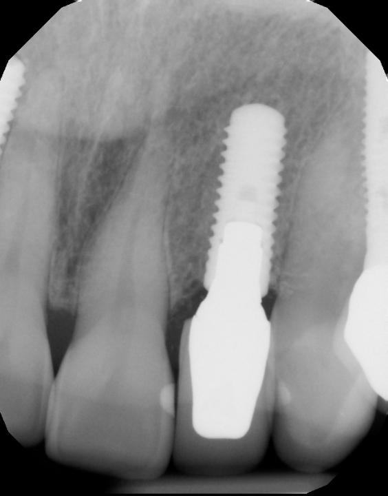 Fig. 3c: Cylindrical implant caused need for additional grafting. A similarly sized tapered implant was not available at the time of surgery. 10-year result shows that despite this macro-design-induced challenge, excellent esthetic results and tissue stability were achieved. a: surgical placement with significant apical protrusion of the cylindrical implant. b: 10-year clinical result showing stable tissue contours. C: 10-year radiograph showing stable proximal bone levels