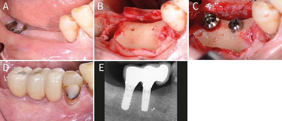 Fig. 4: Implant placement in a 89-year-old woman. An implant with 3.3 mm diameter is inserted into the healed bone of the previous pontic area after the failure of a FPDP (A). The vertical ridge reduction (B) coupled with the reduced implant diameter leads to standard implant placement without bone grafting (C). An adjacent regular diameter implant enables a mesial cantilever unit with successful clinical (D) and radiological (E) findings after 4 years in function