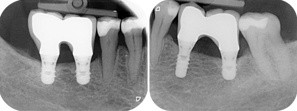 Fig. 1c: Radiographs taken 5 years after loading. No alteration in sensation was reported by the patient