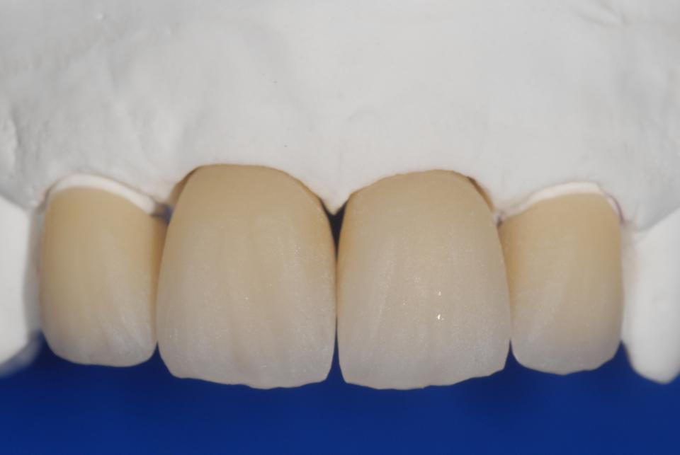Fig. 6i: Facial close-up view of the four all-ceramic restorations on the master model at their bisque bake stage