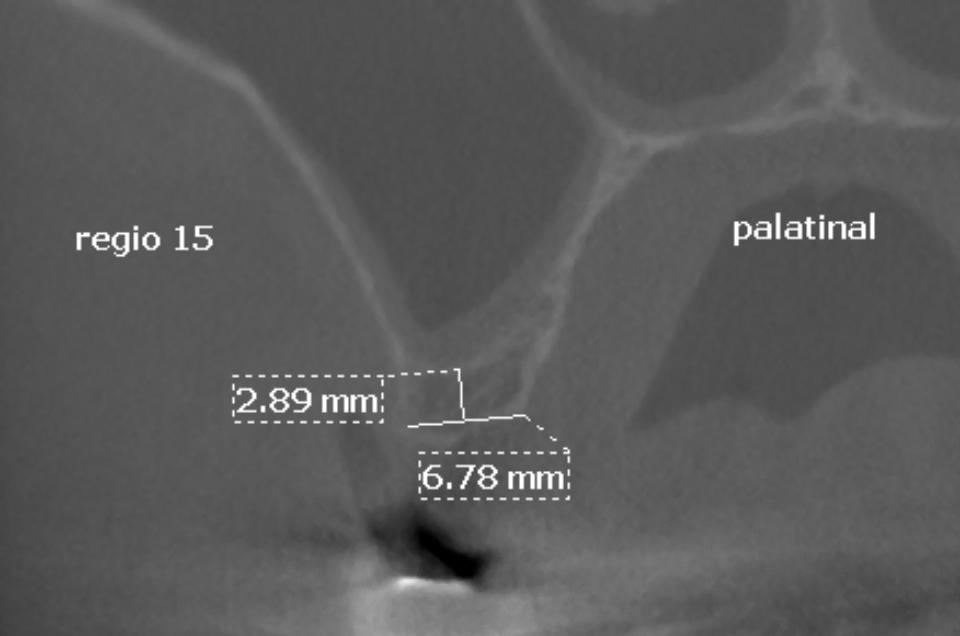 Fig. 2e: The oro-facial CBCT in area #15 shows sufficient crest width, but a ridge height of less than 4 mm