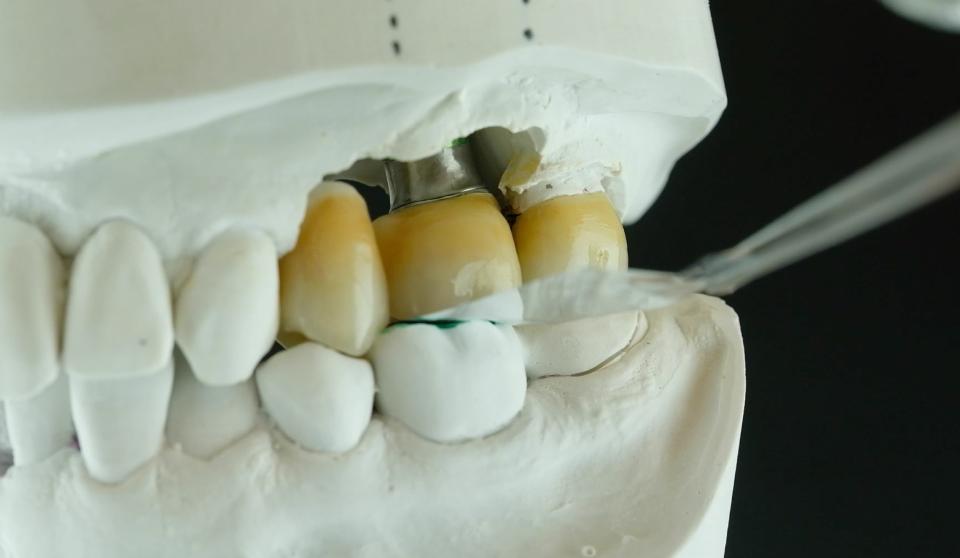 图 3: 种植单牙修复体的咬合间隙。在轻中度咬合的情况下，不与shimstock咬合箔接触
