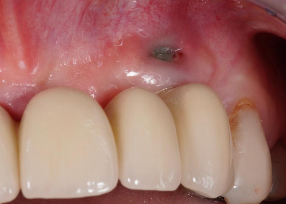 Fig. 17a: Inadequate buccal bone thickness has resulted in loss of soft tissue support and the subsequent development of a fenestration. A high level of patient motivation in performing oral hygiene measures prevented further expansion of the dehiscence, however this was deemed to be both unesthetic and likely to be unstable in the long-term