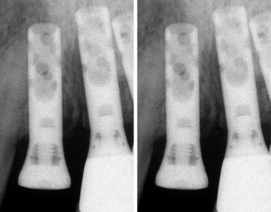 Figs 8c: The two x-rays reveal the coronally malpositioned three implants. Furthermore, the implant shoulder 22 has been located too close to both the adjacent implant 21 and tooth 23