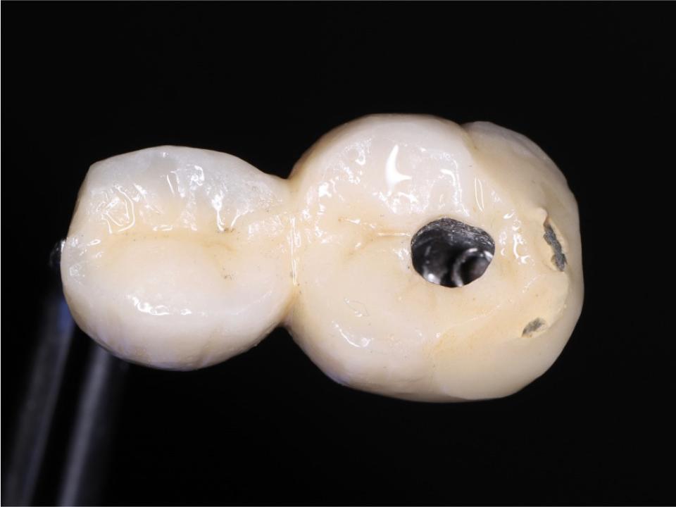 Fig. 5d: Complicação técnica: imagem de lascamento de porcelana de coroas esplintadas implantossuportadas (imagem cortesia do Prof. Edward Chaoho Chien)