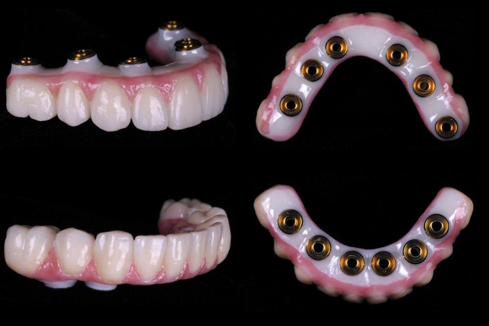 Fig. 32: Milled definitive zirconia prostheses ready for delivery