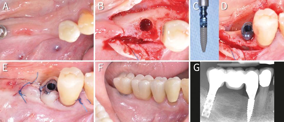 Fig. 5: Pronounced horizontal atrophy after failure of an implant in area 45 after 30 years in function and loss of the implant restoration in a 80-year-old woman (A). A 2.9 mm implant (B) is inserted in the failed site without need for bone grafting (C, D) and heals transmucosally (E). Splinting to the surviving implant in area 47 allows for full fixed rehabilitation of the area. Clinical (F) and radiological (G) findings after 1 year in function