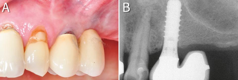 Fig. 12: A cantilever restoration allowed to avoid maxillary sinus grafting procedures. Clinical (A) and radiological (B) findings after 10 years in function