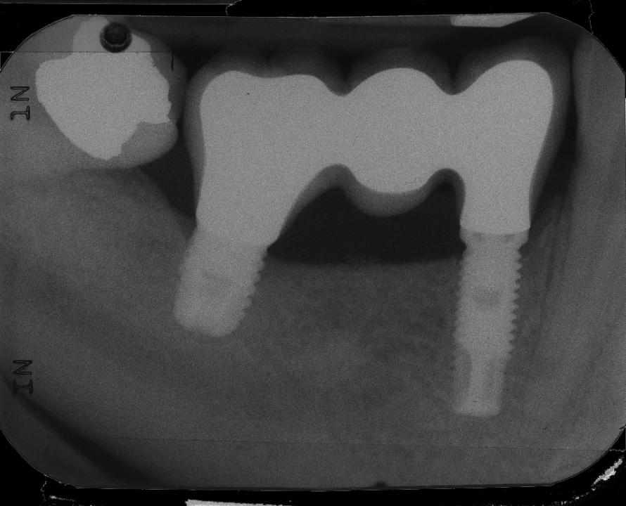 Fig. 4: Two-piece implants supporting a FDP in the mandible